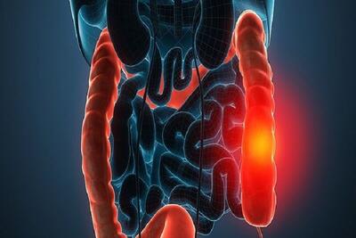سرطان روده بزرگ، خطرناک اما قابل پیشگیری