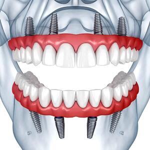 قیمت ایمپلنت همه دندانها چقدر است ؟ ( فول موس )