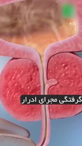 مشکلات پروستات بعد از 40 سالگی در آقایان