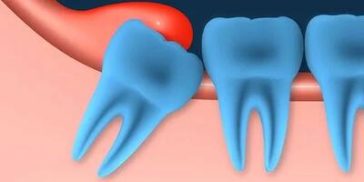 همه چیز در مورد دندان عقل نهفته؛ علائم، کشیدن و جراحی آن