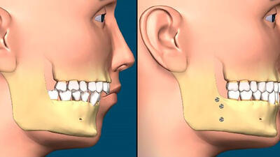 آیا جراحی فک باعث مرگ می شود؟ / رعایت بهداشت دهان و دندان پس از جراحی فک را جدی بگیرید