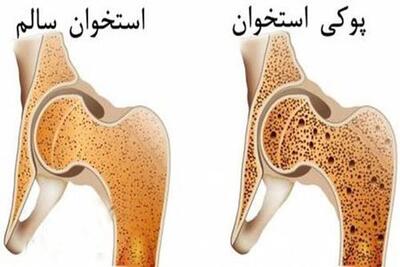 چه کار کنیم استخوان های مان پوک نشوند؟