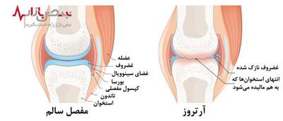ضربه مهلک به آرتروز زانو با کشف جدیدی که زانوهای شما را نجات می‌دهد