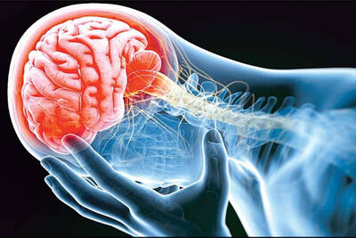تلاش محققان ایرانی برای درمان عوارض ناشی از سکته مغزی