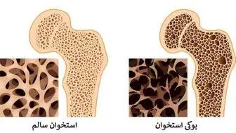 اندیشه معاصر- پوکی استخوان سراغ چه کسانی می‌رود؟ اندیشه معاصر