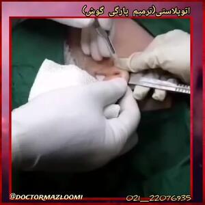 دکتر سید حسن مظلومی: ترمیم و درمان پارگی گوش
