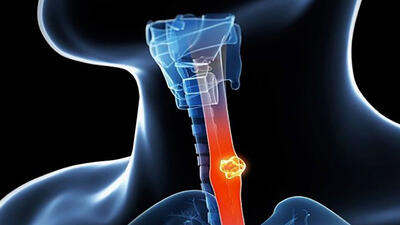 سالانه 2000 نفر به سرطان مری مبتلا می شوند / مردان و افراد بالای 50 سال بیشتر در خطرند