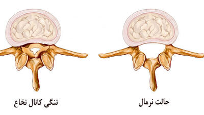 بررسی علت تنگی کانال نخاعی