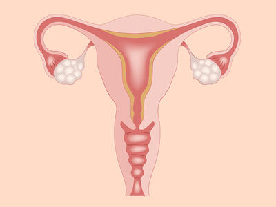 تفاوت تنبلی تخمدان و کیست تخمدان چیست؟