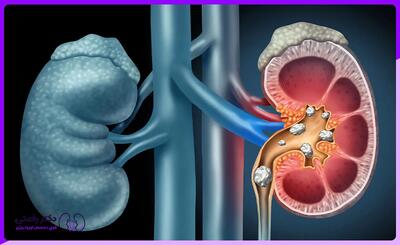 آیا ارتباطی بین سنگ کلیه و یبوست وجود دارد؟