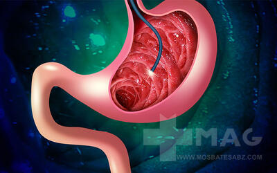 0 تا 100 چیزی که باید درباره آندوسکوپی معده بدانید