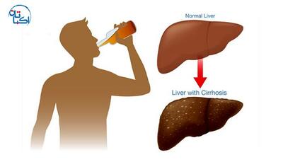 چرا باید مراقب تأثیر الکل بر کبد باشیم؟