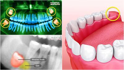 دندان عقل و مشکلات احتمالی آن + عکس