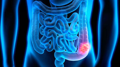 سالانه بین 20 تا 25 هزار مورد جدید ابتلا به سرطان روده در ایران مشاهده می شود