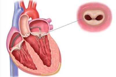 گشادی دریچه قلب چیست و چگونه درمان می شود؟ - کاماپرس