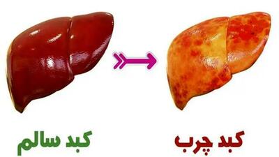 بهترین رژیم غذایی برای غلبه بر کبد چرب