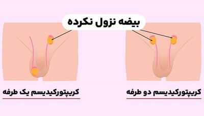 چند درصد نوزادان پسر با بیضه نزول نکرده متولد می شوند؟