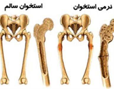با بیماری نرمی استخوان بیشتر آشنا شوید!