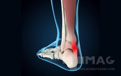 آشنایی با تاندون آشیل، آسیب ها و نقش آن در زندگی روزمره