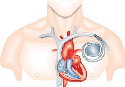 پیوند باتری قلب به روش نیمه‌تهاجمی در کرج - تسنیم