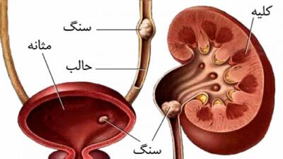 قوی ترین داروی گیاهی برای درمان سنگ کلیه!