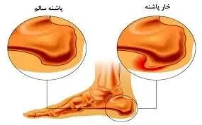 اندیشه معاصر- خارپاشنه عذابتان می‌دهد؟ بخوانید! اندیشه معاصر