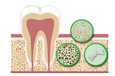 تشخیص پوکی استخوان از روی دندان ها