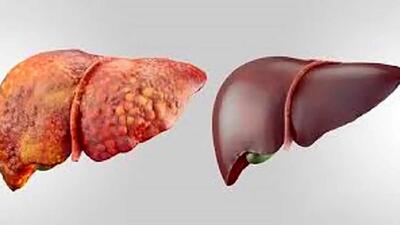 جلوگیری از پیشرفت بیماری کبد با داروی دیابت