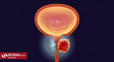تشخیص سرطان پروستات با هوش مصنوعی ایرانی