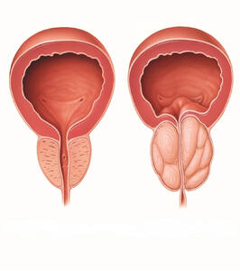 علت بزرگ شدن پروستات چیست؟