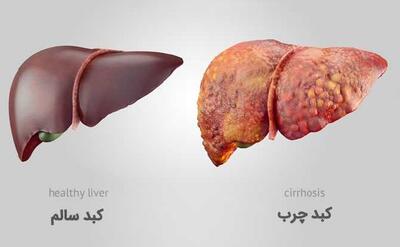 راز شگفت انگیز کاهش کبد چرب در ۳۰ دقیقه