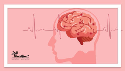 ضرورت توجه به سکته مغزی در سنین پایین