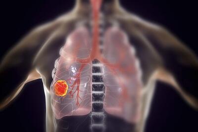 میکروتراشه‌ای برای تشخیص زودهنگام سرطان ریه