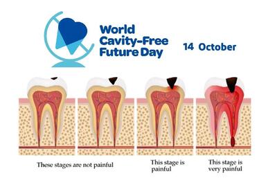 ۱۴ اکتبر روز جهانی بدون پوسیدگی دندان است