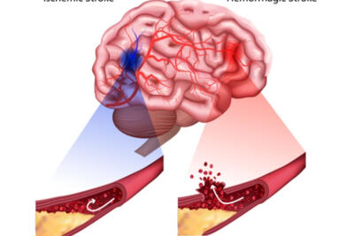 سکته مغزی  1.5 برابر متوسط جهانی و دومین عامل مرگ و میر در کشور