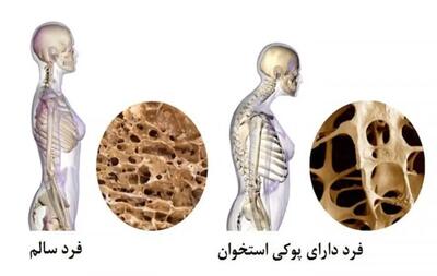 این علائم نشان دهنده  پوکی استخوان است!!