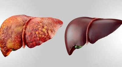 درمان سریع کبد چرب با این روش بدون هزینه خانگی