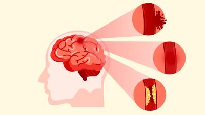 هشدار | سن شروع سکته مغزی کاهش پیدا کرده است