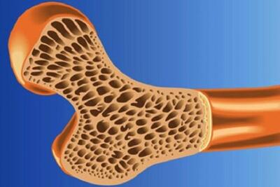 پوکی استخوان در نیمی از جمعیت کشور - روزنامه رسالت