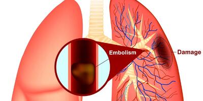 آیا این علائم را دارید؟ آمبولی ریه را جدی بگیرید! (اینفوگرافیک)