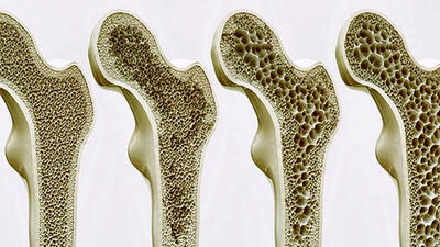 غربالگری رایگان پوکی استخوان
