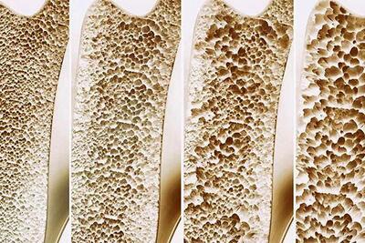 این علائم از پوکی استخوان خبر می‌دهند