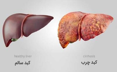 کبد چرب چه علائمی دارد و چگونه درمان می شود؟