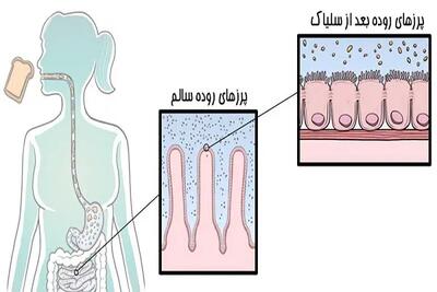 اندیشه معاصر - بیماری سلیاک/علائم و راه درمان بیماری سلیاک اندیشه معاصر