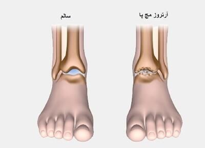 علت درد مچ پا هنگام راه رفتن