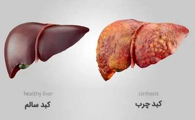 چگونه کبد چرب را درمان کنیم؟