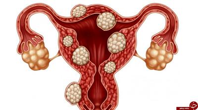 هشدار متخصصان درباره درمان فیبروم با روش‌های سنتی
