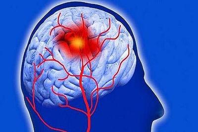 سکته مغزی اولین علت ناتوانی در کشور