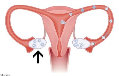 این خوراکی‌ها کیست تخمدان را تشدید می‌کنند