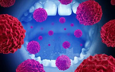 سرطان دهان + تصاویر سرطان دهان